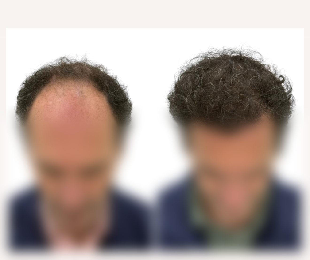 Caso real de injerto capilar del Doctor Merlos — antes y después (1)