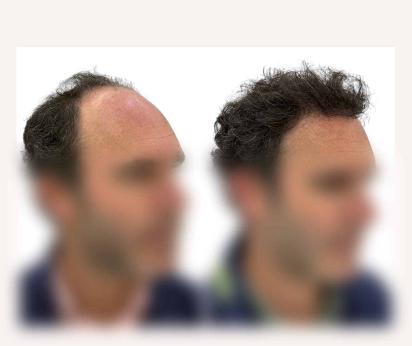 Caso real de injerto capilar del Doctor Merlos — antes y después (2)