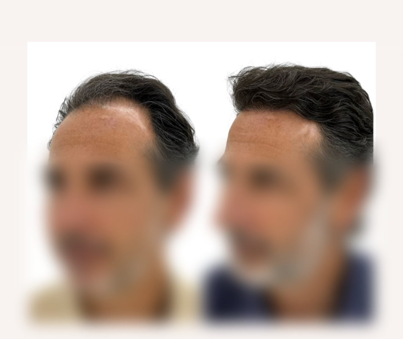 Caso real de injerto capilar del Doctor Merlos — antes y después (3)