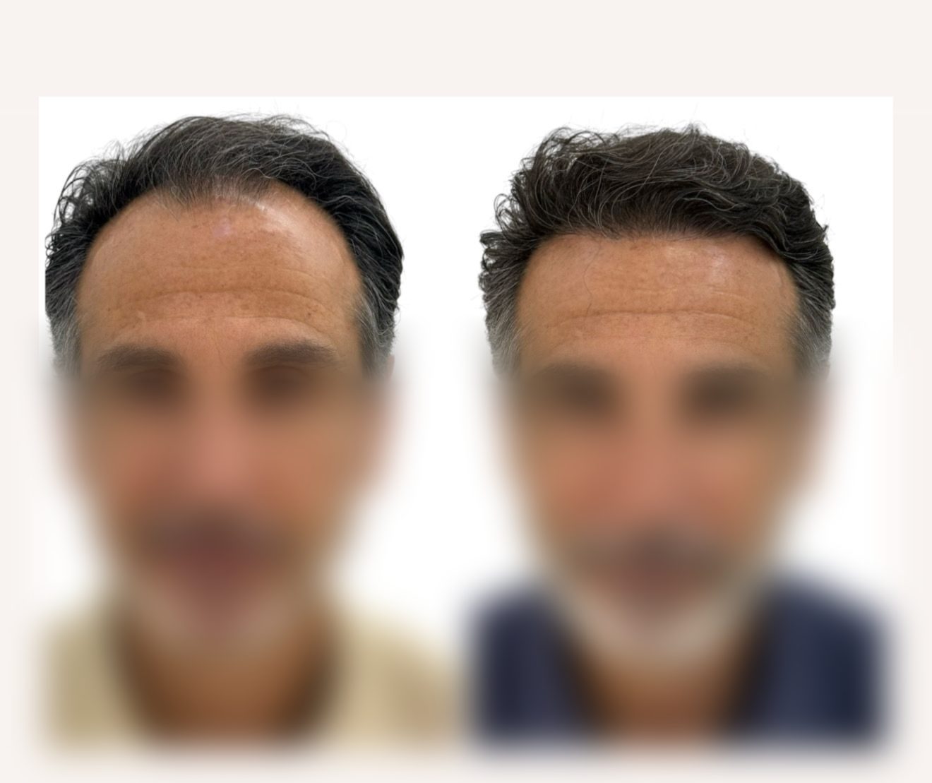 Caso real de injerto capilar del Doctor Merlos — antes y después (5)