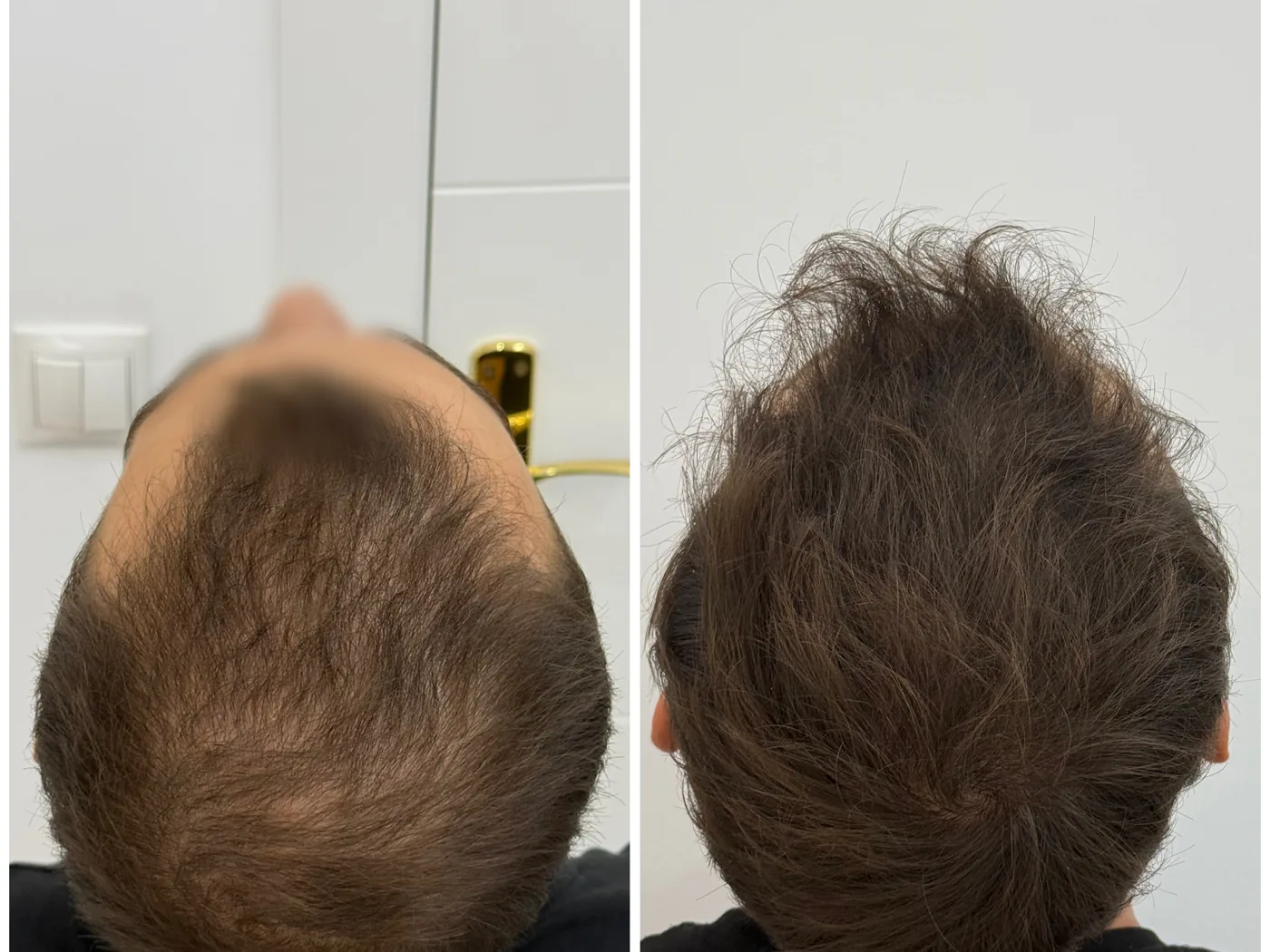 Antes y después de un tratamiento de mesoterapia capilar en la clínica del Dr. Merlos en Barcelona