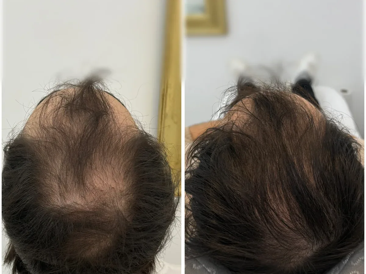 Caso real de mesoterapia capilar en la clínica del Dr. Merlos en Barcelona (4)